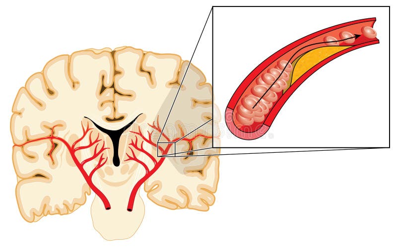 Бляшка в головном мозге. Атеросклероз головного мозга. Атеросклероз артерий головного мозга картинки. Атеросклероз головного мозга 80 процентов.