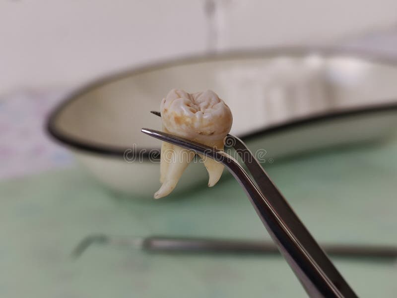 К чему снится вытащить зуб без крови. Фото какими клещами вытаскивают зуб.