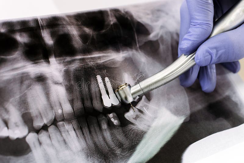 Рентген зуба с инструментом. Рентген назначается после. Рентген зубов реклама. Фото сломанных инструментов в зубе на рентгене.