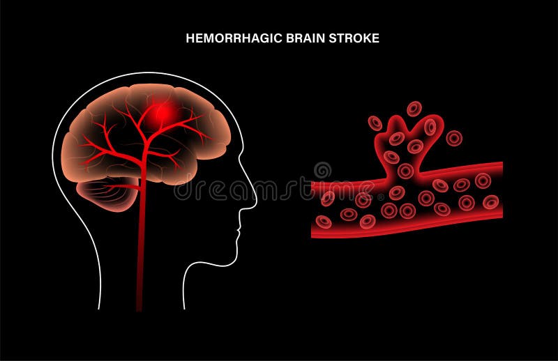 Имеет крови мозга и. The Concept of stroke.