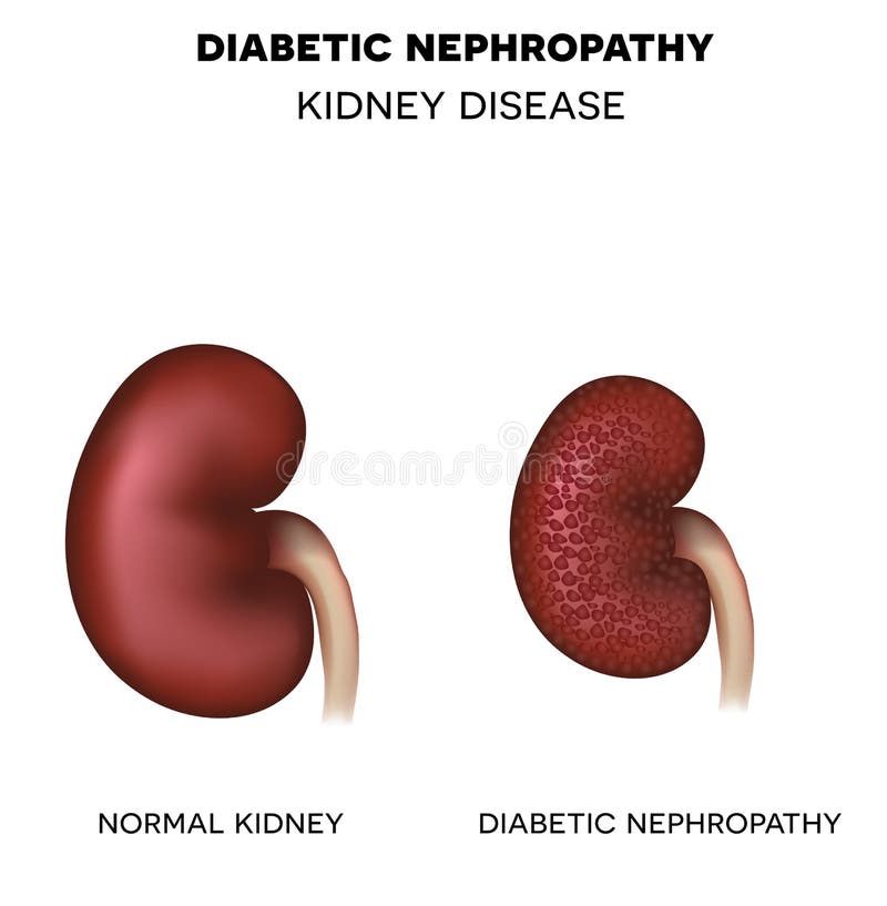 Диабетическая нефропатия