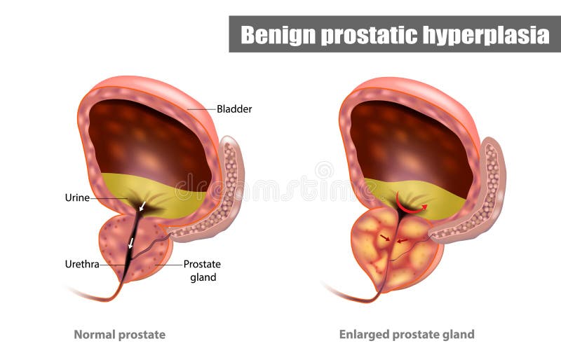 prostatitis makró hematuria