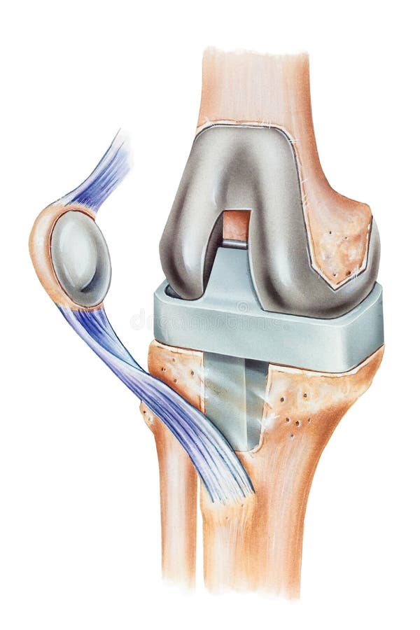Протез коленного сустава. Протез хряща в коленном суставе. Коленный сустав анатомия протез.