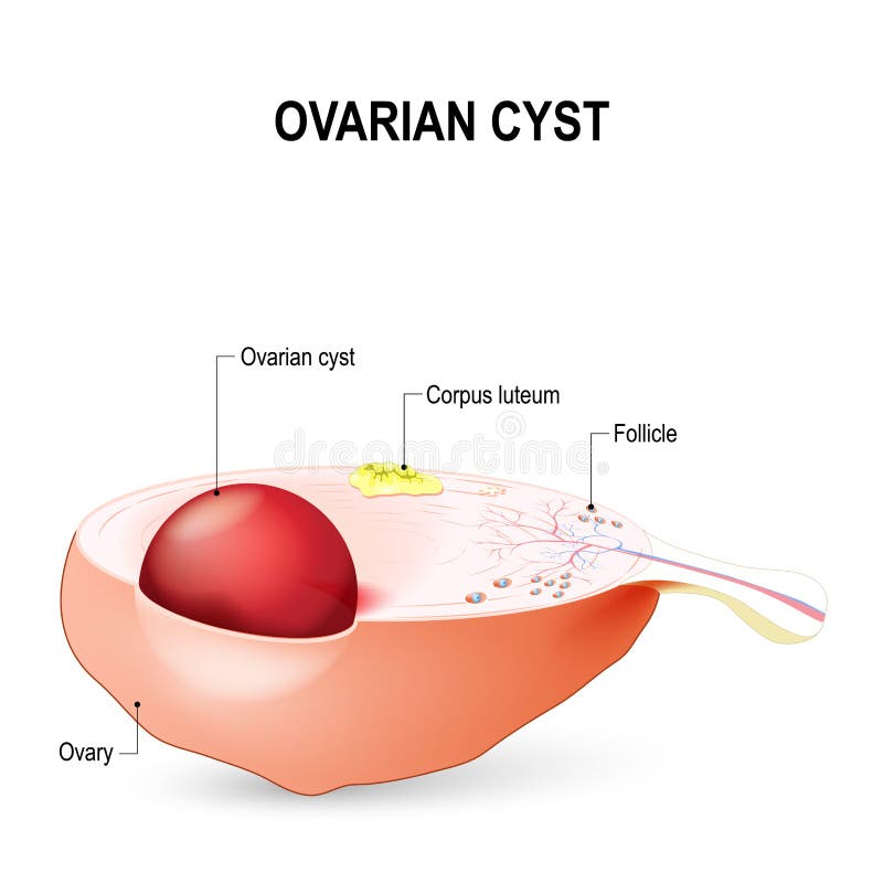 Chocolate ovarian Cysts.