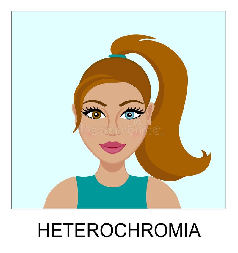 Portrait of a Young Woman with Heterochromia. Different Colored Eyes.  Odd-eyed Girl. Brown and Blue Cornea. Genetic Disorder Stock Vector -  Illustration of heterochromia, fashion: 200549458