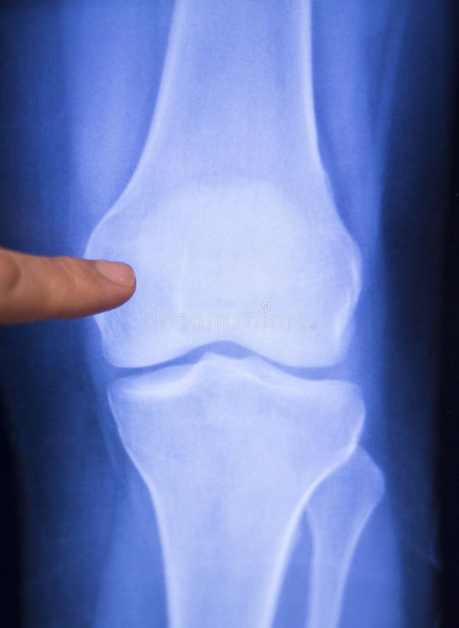 Перелом мениска коленного сустава рентген. Мениск коленного сустава рентген. Разрыв мениска снимок рентген.