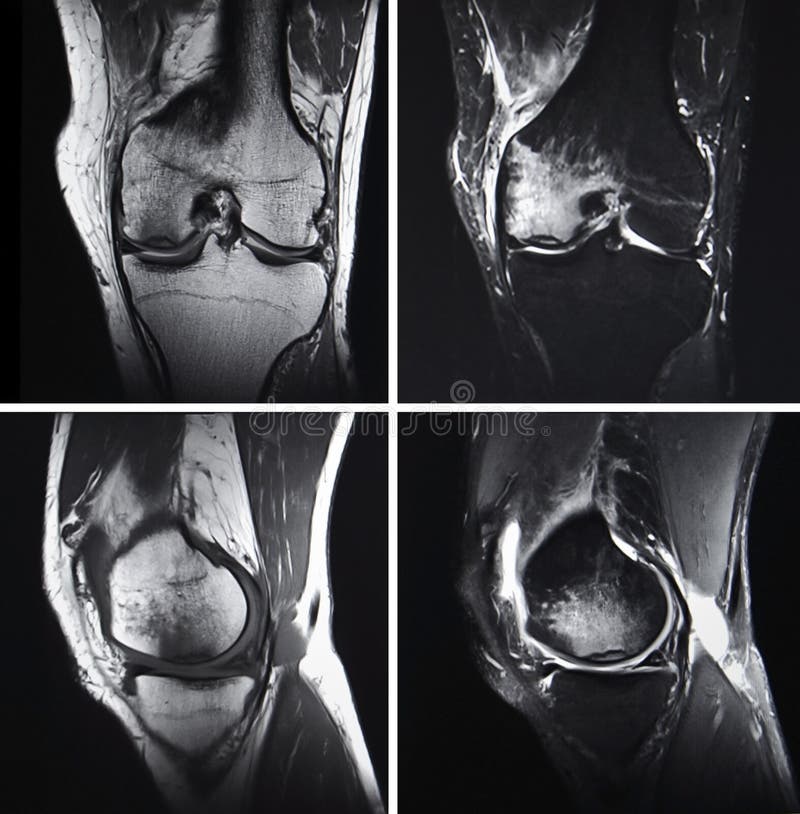 Мрт коленного сустава омс. Остеохондральное повреждение мрт.