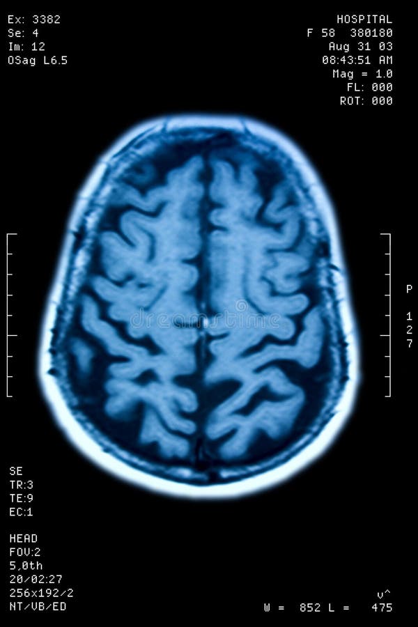 Мозг резонанс. Мозг в скане stock. Глиоз полушарий мозга