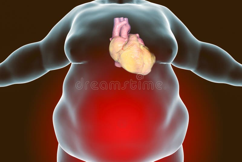Ожирение и сердечно сосудистые заболевания. Сердце при ожирении фото. Сердце и сосуды ожирение.
