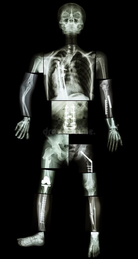 Переломы скелета. Скелет рентген. Рентген человека. Рентген скелета человека.