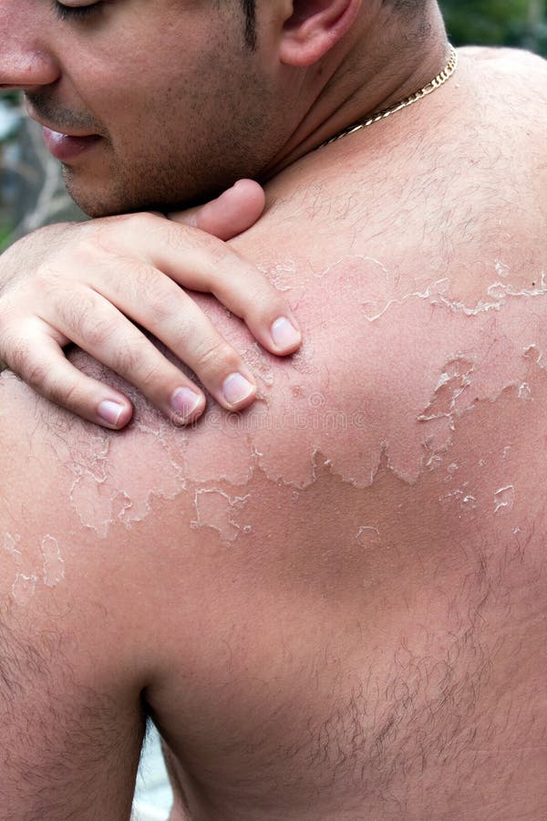 The mole guide: what does a cancerous mole look like? - Harley Medical Group