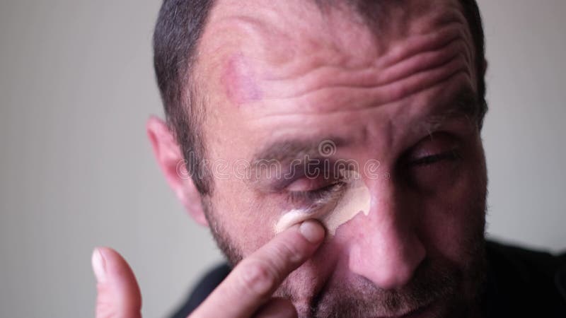 У Человека Синяк Под Глазом, Намазанный Кремом Для Гематомы. Сток.