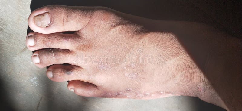 亚洲成年男性足皮损伤库存图片 图片包括有人员 鼻子 肌肉 现有量 手指 器官 眼睛