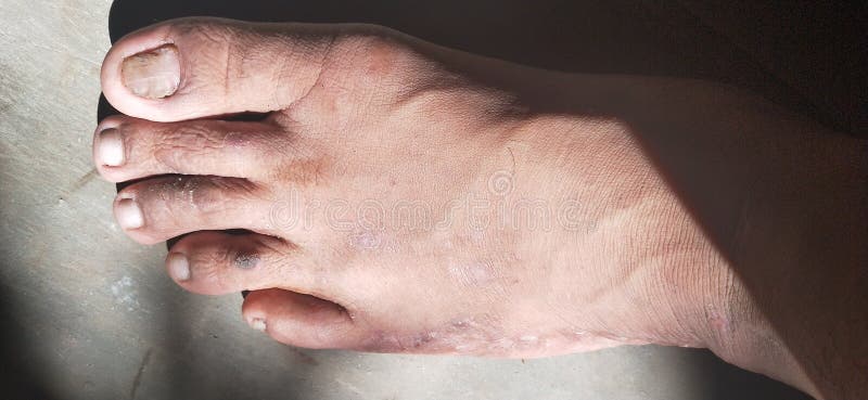 亚洲成年男性足皮损伤库存图片 图片包括有人员 鼻子 肌肉 现有量 手指 器官 眼睛 亚洲成年男性足皮损伤库存图片 图片包括有人员 鼻子 肌肉 现有量 手指 器官 眼睛