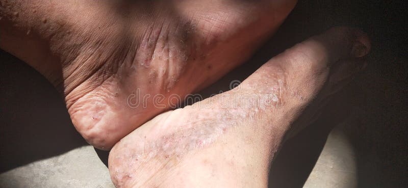 亚洲成年男性足皮损伤库存图片 图片包括有人员 鼻子 肌肉 现有量 手指 器官 眼睛 亚洲成年男性足皮损伤库存图片 图片包括有人员 鼻子 肌肉 现有量 手指 器官 眼睛