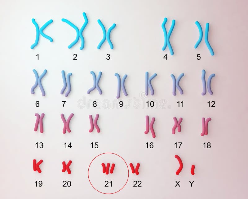唐氏综合症染色体组型图库存例证 插画包括有基因 研究 人力 医学 背包 染色体 显微镜 唐氏综合症染色体组型图库存例证 插画包括有基因 研究 人力 医学 背包 染色体 显微镜