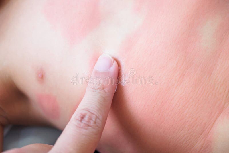 小女孩严重皮疹及过敏症体贴局部抗组胺药膏的医生手库存图片 图片包括有手指 医生 皮炎 奶油 小女孩严重皮疹及过敏症体贴局部抗组胺药膏的医生手库存图片 图片包括有手指 医生 皮炎 奶油