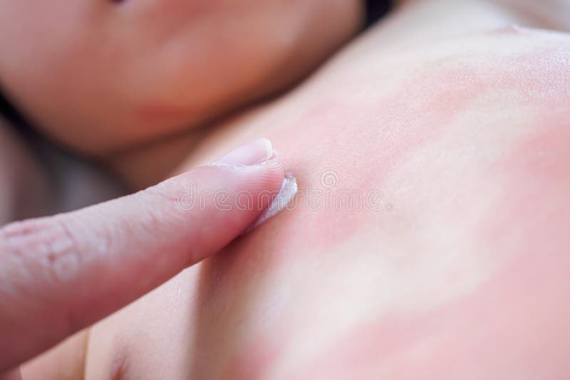 小女孩严重皮疹及过敏症体贴局部抗组胺药膏的医生手库存图片 图片包括有母狗 皮炎 刺耳 反毒素 小女孩严重皮疹及过敏症体贴局部抗组胺药膏的医生手库存图片 图片包括有母狗 皮炎 刺耳 反毒素