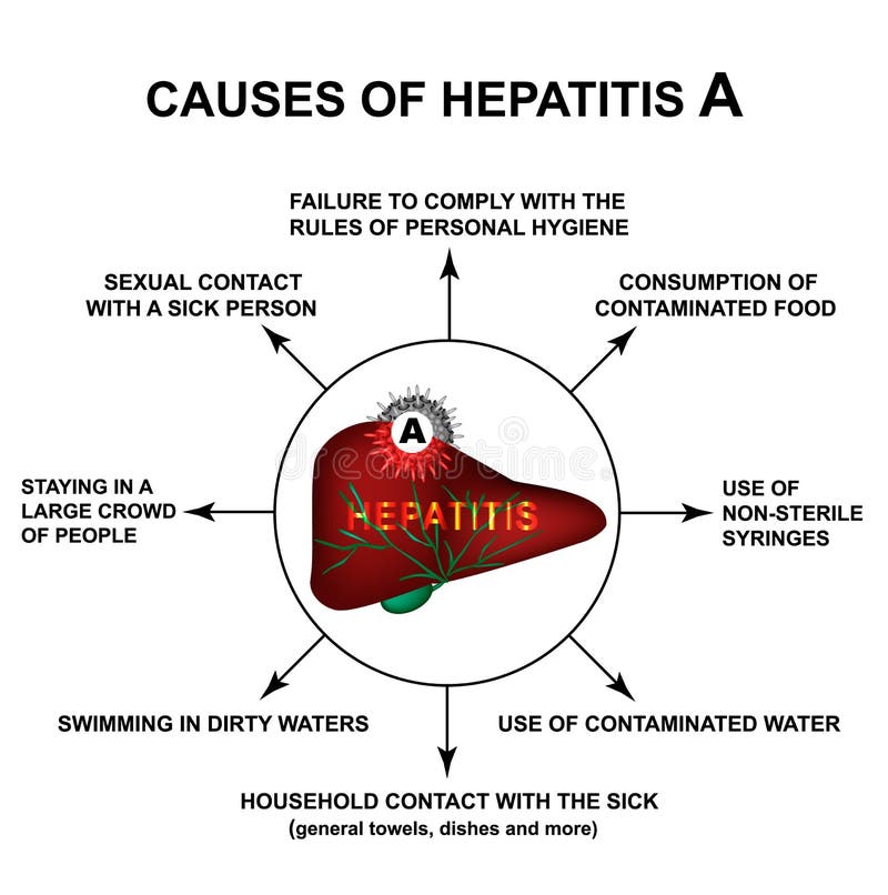 丙型肝炎的原因世界肝炎天infographics R 向量例证 插画包括有infographics 丙型肝炎的原因