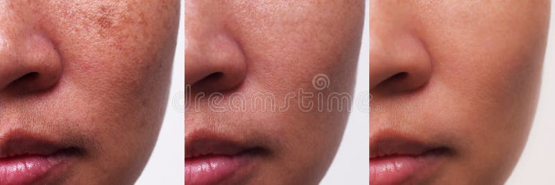 米拉斯玛治疗前后库存照片 图片包括有图象 黑色素 故障 化妆用品 女性 开放 爱好健美者