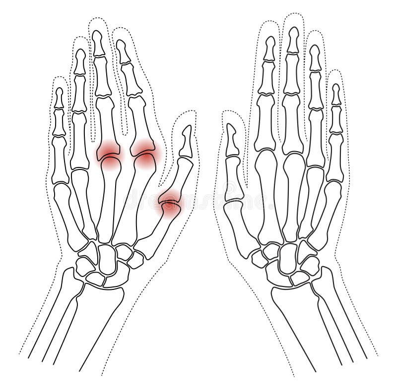 类风湿关节炎骨手白色背景上的手掌和手指图像线性设计库存例证 插画包括有成人 类风湿病