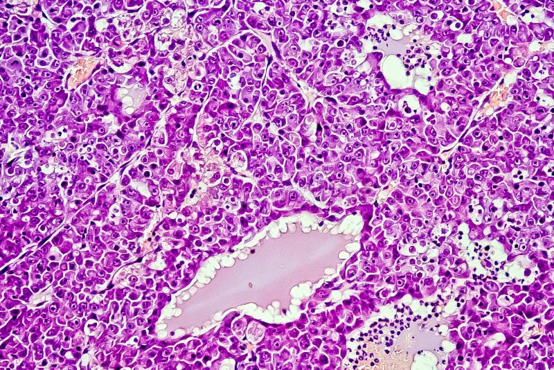肝细胞的癌-在鼠， 60x的肝癌徒升