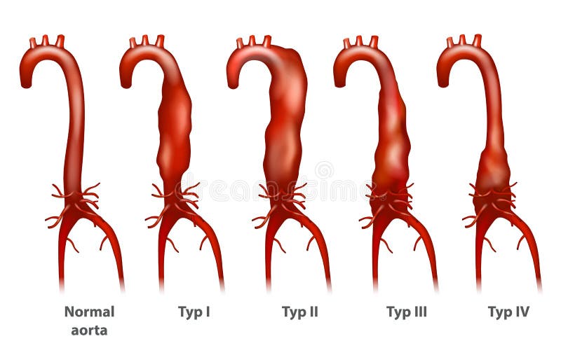 Abdominal aortic aneurysm royalty free illustration