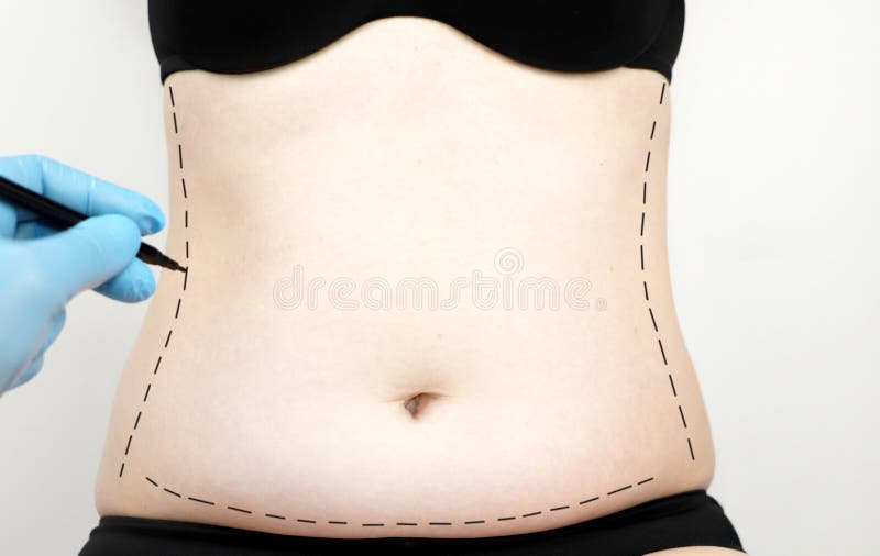 Abdominoplasty and Torsoplasty: Abdominal Liposuction and Removal of the  Apron. the Patient at the Reception at the Plastic Stock Image - Image of  caucasian, medical: 139795341