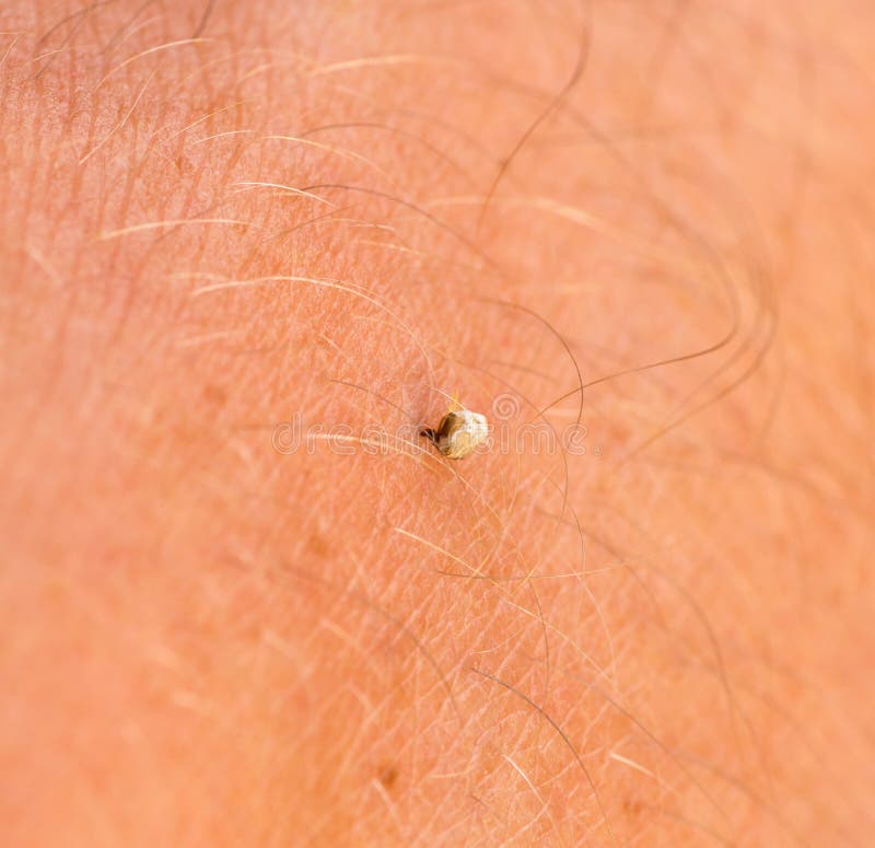Abeille Sting Stuck In Human Skin photographie stock libre de droits Abeille Sting Stuck In Human Skin photographie stock libre de droits