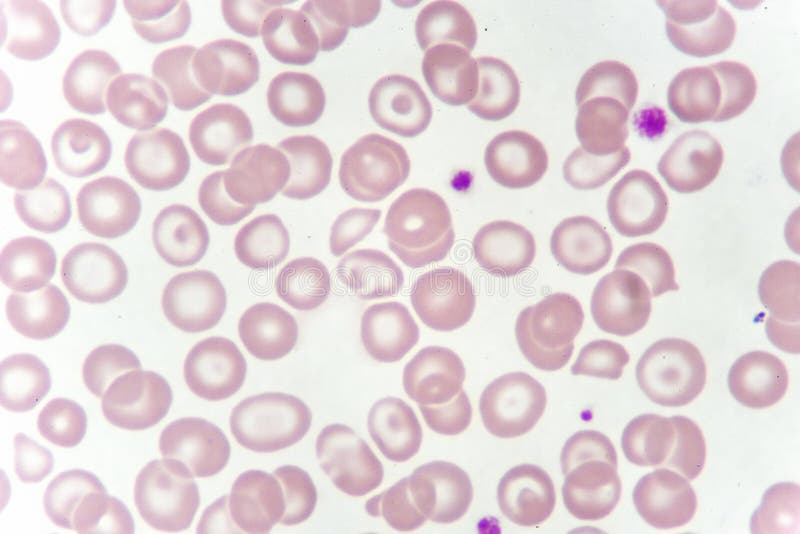 Abnormal red blood cells from anemia patient