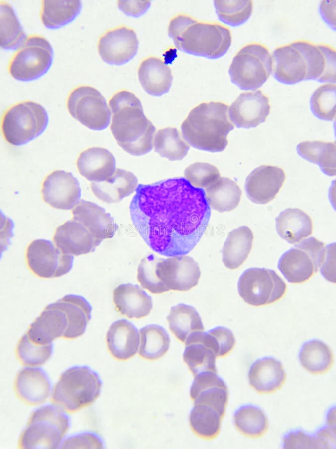 Abnormal white blood cells stock image. Image of cell 97102099