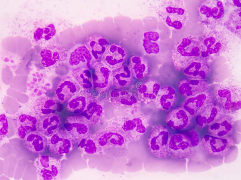 Abnormale neutrophil in borstvlies vloeibare vlek stock fotografie Abnormale neutrophil in borstvlies vloeibare vlek stock fotografie