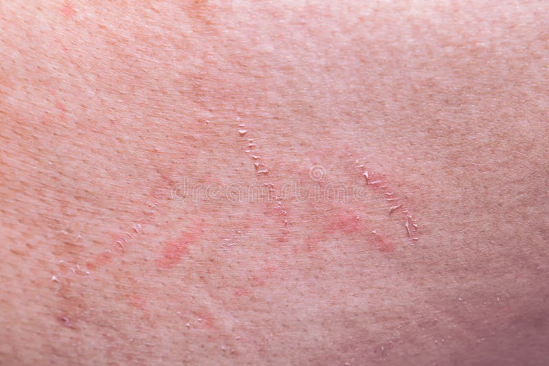 Abrasion Wound Stock Photos Download 891 Royalty Free Photos