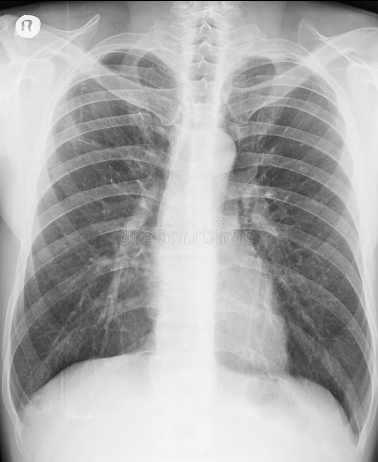 X-ray. A chest radiograph, PA posteroanterior view. Two years after spontaneous pneumothorax. Signs of collapse of the lung parenchyma are not visible. Lung fields with persistent pulmonary opacities without signs of infiltration in lung parenchyma. Both hemidiaphragms are sharp, and clearly delineated. Phrenicocostal sinuses are clear. Normal anatomy of pulmonary vessels. X-ray. A chest radiograph, PA posteroanterior view. Two years after spontaneous pneumothorax. Signs of collapse of the lung parenchyma are not visible. Lung fields with persistent pulmonary opacities without signs of infiltration in lung parenchyma. Both hemidiaphragms are sharp, and clearly delineated. Phrenicocostal sinuses are clear. Normal anatomy of pulmonary vessels.