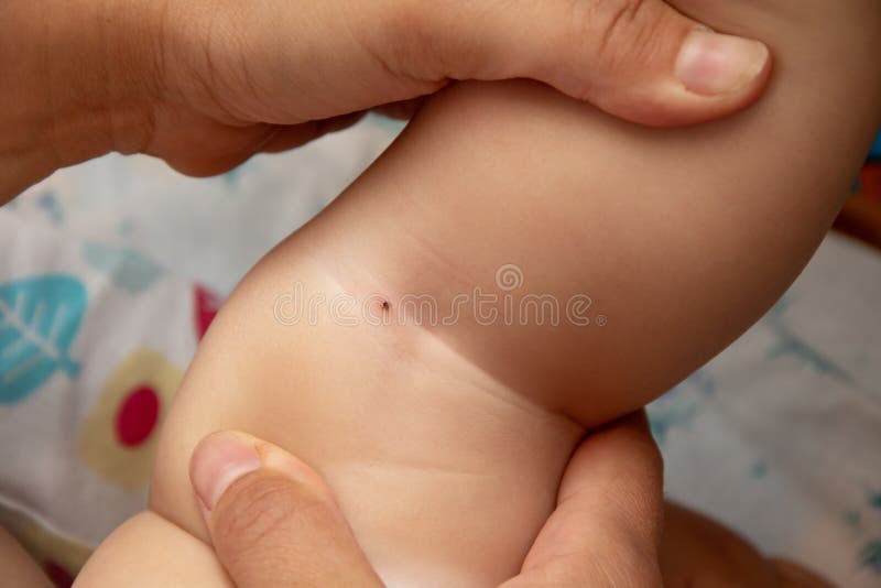 Acarides creusés dans la peau d'un petit enfant, le danger de l'été dans les bois photographie stock Acarides creusés dans la peau d'un petit enfant, le danger de l'été dans les bois photographie stock