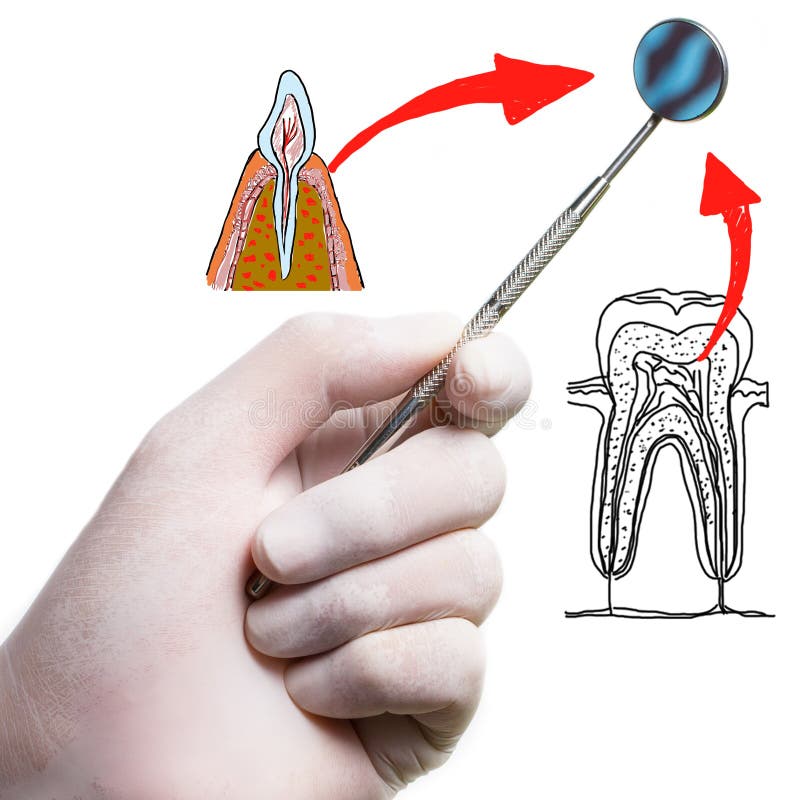 Accessory tool dentist stock photo. Image of sharp, instrument 32309752