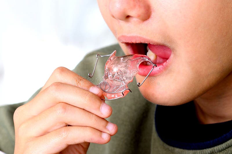Accolades dentaires. adolescent portant appareil orthodontique traitement dentaire pour améliorer l'écart de morsure. photographie stock