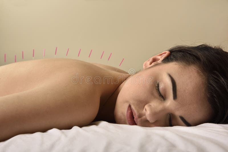Accupuncture på kinesisk medicin för rygg royaltyfria foton Accupuncture på kinesisk medicin för rygg royaltyfria foton