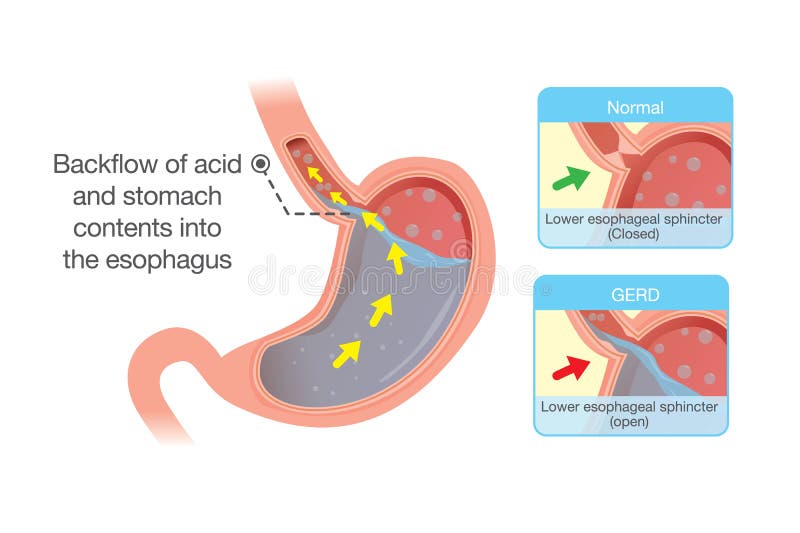 Acide Dans Le Support D'estomac Dans L'oesophage Illustration de