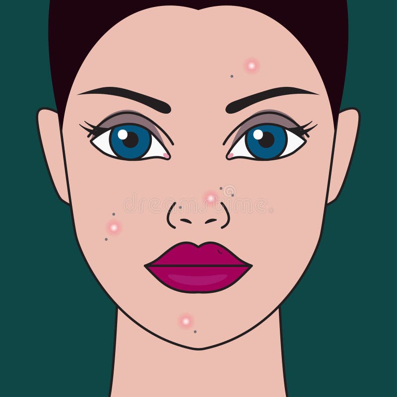 Acne on face of girl stock vector. Illustration of blemish - 107543697