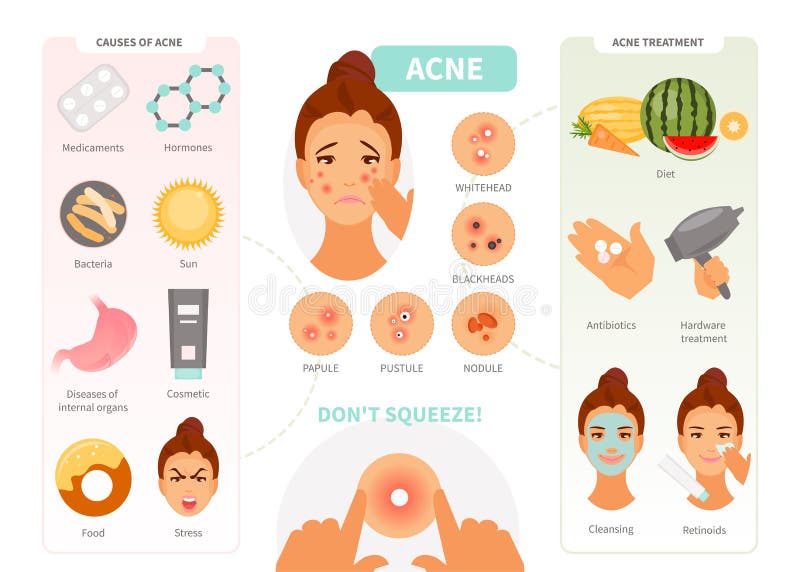 Acne infographic vector stock illustration Acne infographic vector stock illustration