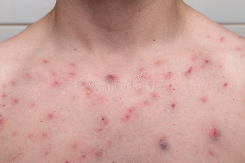 Acne Vulgaris Chest