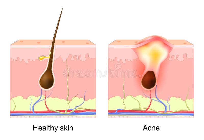 Acne Pimple. Normal Hair Follicle and Clogged Pore Stock Vector -  Illustration of anatomy, clogged: 254180857