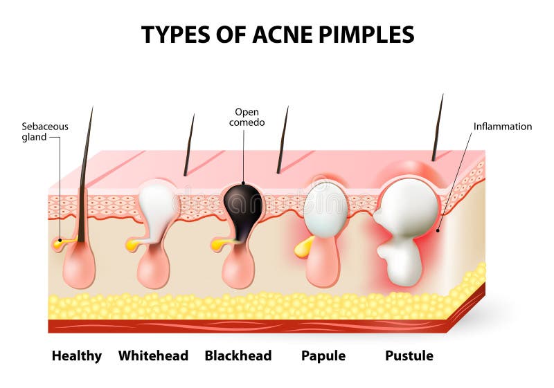 Acne pimples stock vector. Illustration of medical, inflammation - 69939897