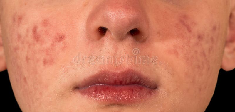 Acne severa fotos de stock Acne severa fotos de stock