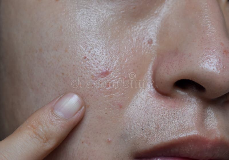 acne vulgaris and scars over whole face of Southeast Asian woman Acne  occurs when hair follicles become plugged with oil and dead cells It  causes wh Stock Photo  Alamy
