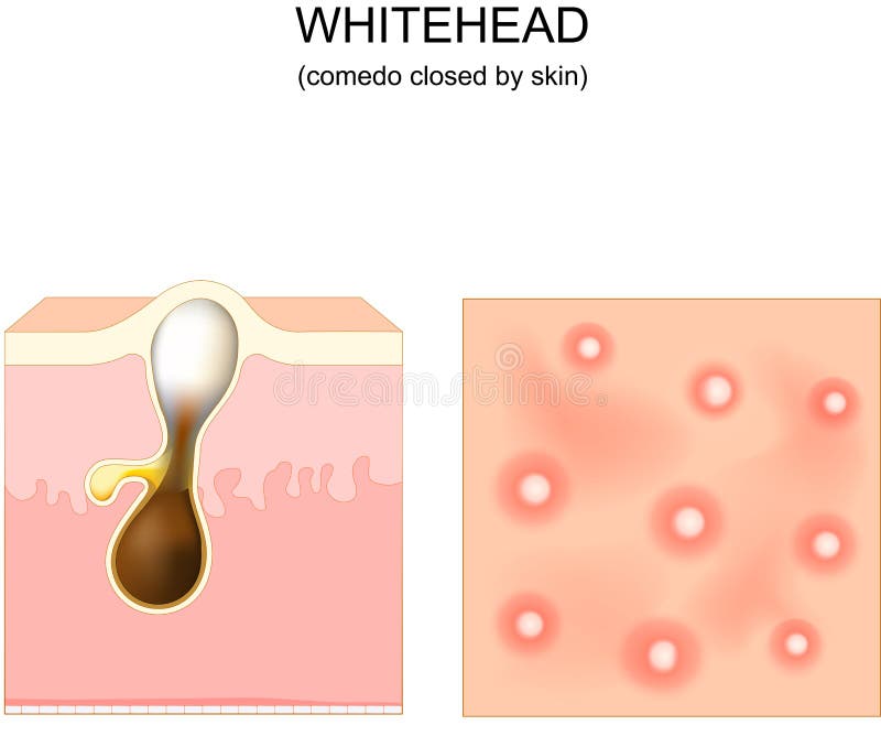 Acne. Whitehead. Cross-section of a Human Skin with Hair Follicle Stock Vector - Illustration of dermatology, hair: 237439780 Acne. Whitehead. Cross-section of a Human Skin with Hair Follicle Stock Vector - Illustration of dermatology, hair: 237439780