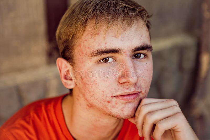 Acne stock photo. Image of tongs, human, wound, acne 77292942