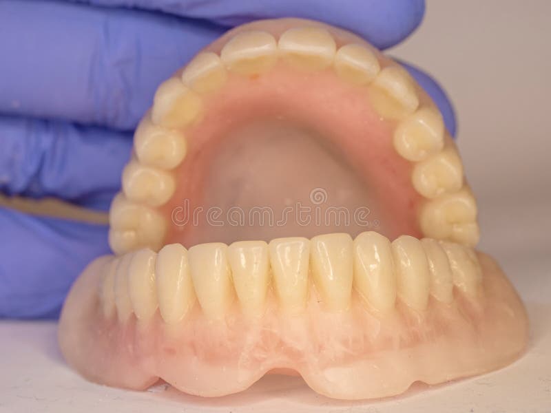 Acrylic Dental Prosthesis with Metal Retaining Elements Stock Photo