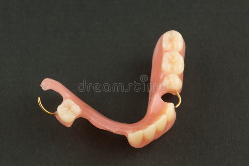 Acrylic Dental Prosthesis with Metal Retaining Elements Stock Photo